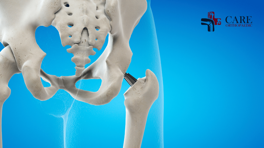 Hip Replacement Surgeon in Delhi