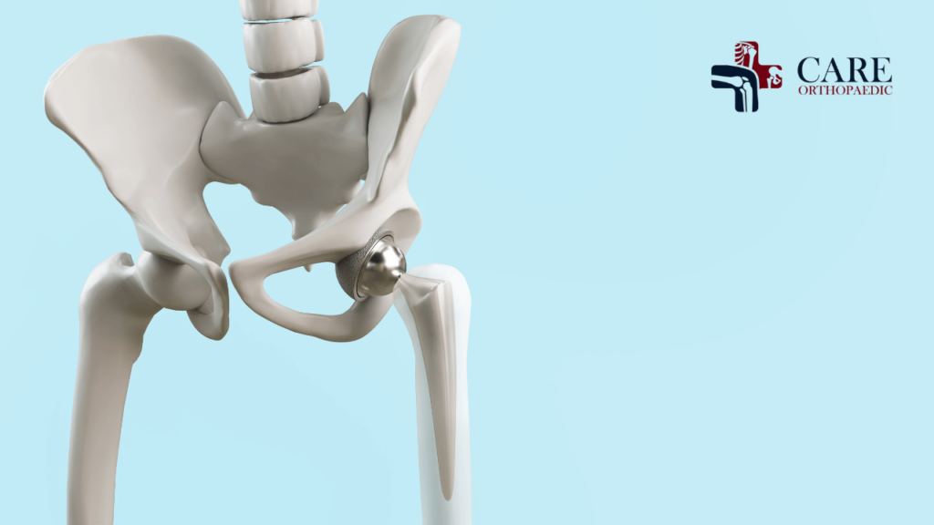 Hip Replacement Surgeon in Delhi