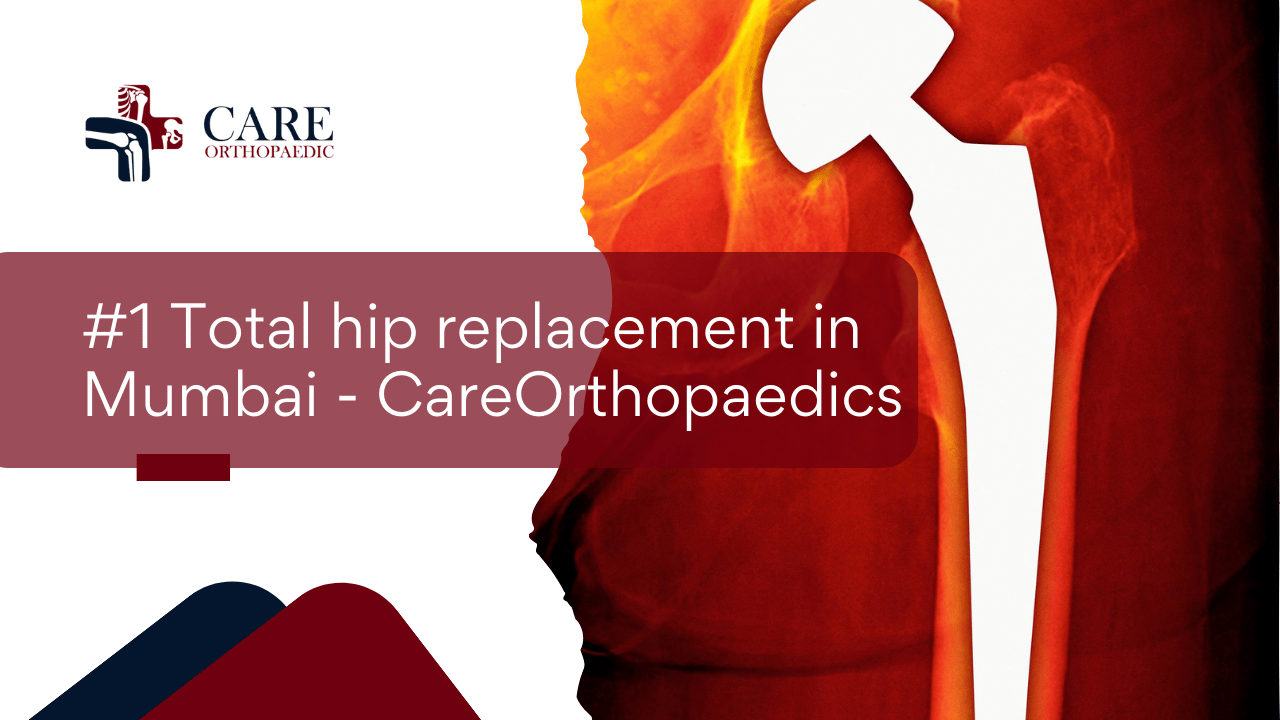 #1 Total hip replacement in Mumbai – CareOrthopaedics