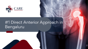 Direct Anterior Approach