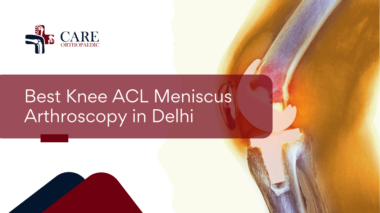 Best Knee ACL Meniscus Arthroscopy in Delhi